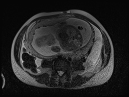 Closed loop small bowel obstruction in pregnancy (MRI) (Radiopaedia 87637-104031 D 10).jpg