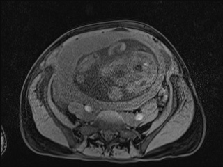 Closed loop small bowel obstruction in pregnancy (MRI) (Radiopaedia 87637-104031 F 31).jpg