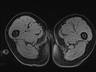 Closed loop small bowel obstruction in pregnancy (MRI) (Radiopaedia 87637-104031 G 50).jpg