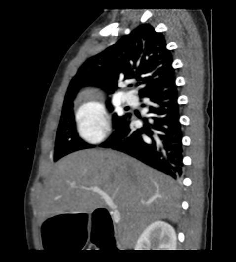 Coarctation of aorta (Radiopaedia 27427-27622 Sagittal C+ CTPA 36).png
