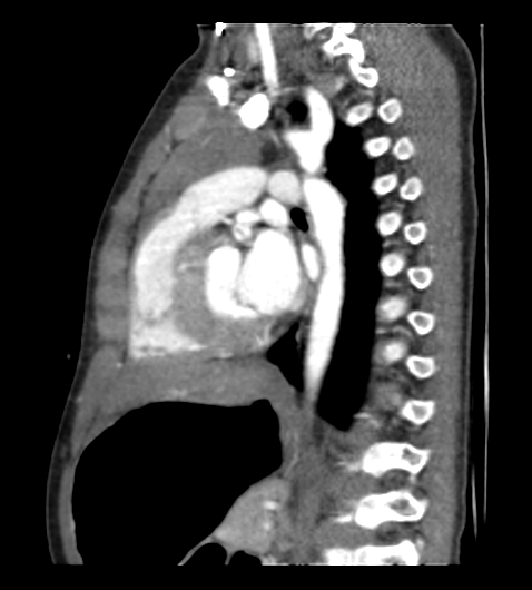 Coarctation of aorta (Radiopaedia 27427-27622 Sagittal C+ CTPA 79).png