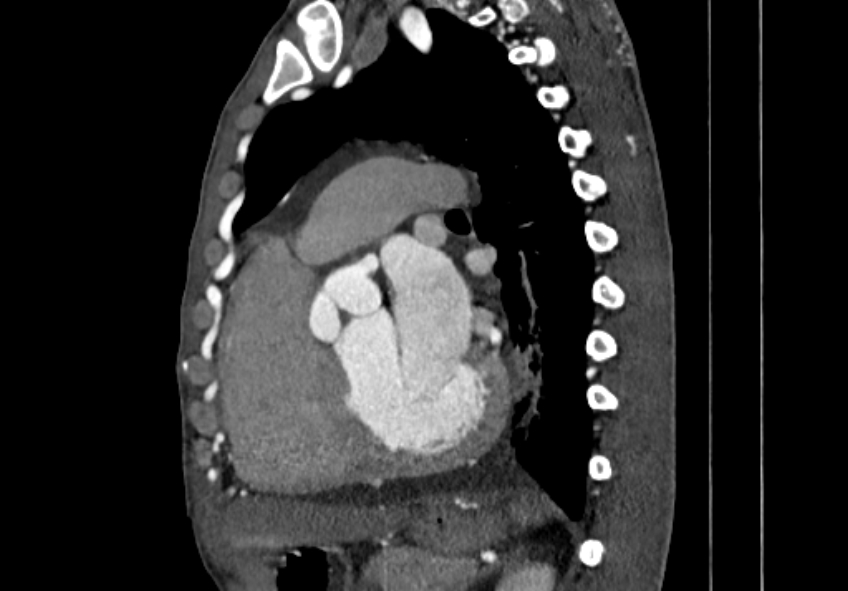 Coarctation of aorta with aortic valve stenosis (Radiopaedia 70463-80574 B 96).jpg