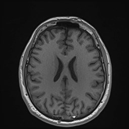 File:Cochlear incomplete partition type III associated with hypothalamic hamartoma (Radiopaedia 88756-105498 Axial T1 125).jpg