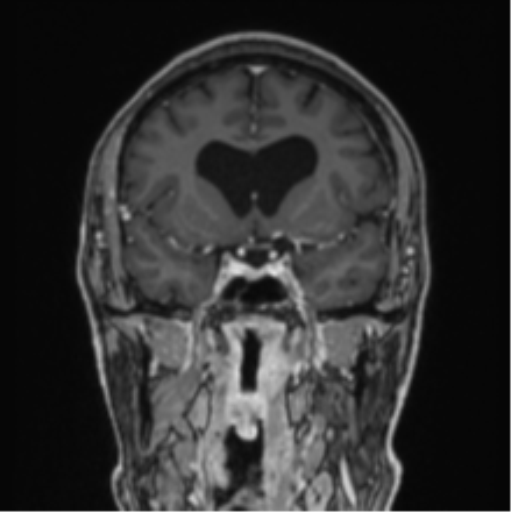 File:Colloid cyst of the third ventricle (Radiopaedia 86571-102662 Coronal T1 C+ 59).png