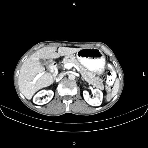 Colon adenocarcinoma - hepatic flexure (Radiopaedia 85635-101395 A 28).jpg