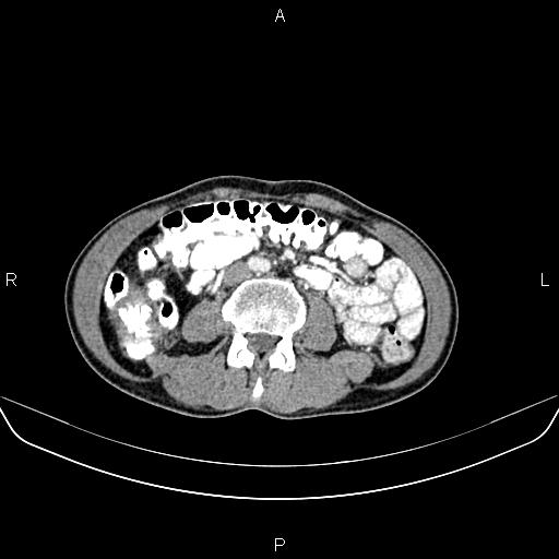 Colon adenocarcinoma - hepatic flexure (Radiopaedia 85635-101395 A 49).jpg