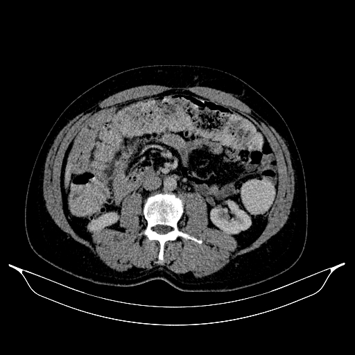 Colonic diverticulosis (Radiopaedia 72222-82744 A 7).jpg