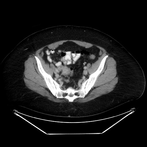 File:Colonic intussusception due to adenocarcinoma (Radiopaedia 86828-102987 A 120).jpg