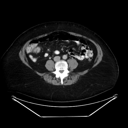 File:Colonic intussusception due to adenocarcinoma (Radiopaedia 86828-102987 A 92).jpg