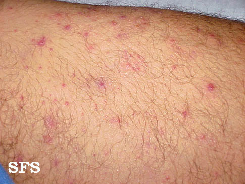 File:Folliculitis (Dermatology Atlas 4).jpg
