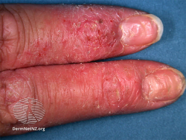 File:Hand dermatitis (DermNet NZ dermatitis-hd-derm).jpg
