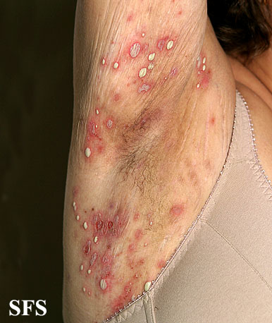 File:Impetigo (Dermatology Atlas 37).jpg