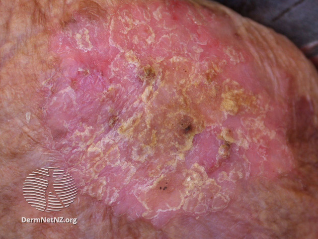 Intraepidermal carcinoma (DermNet NZ lesions-scc-in-situ-2934).jpg