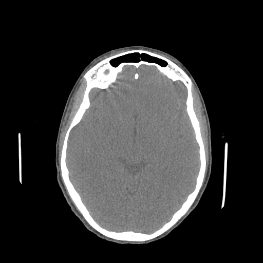 Nasal pyogenic granuloma (lobular capillary hemangioma) (Radiopaedia 85536-101244 Axial non-contrast 128).jpg