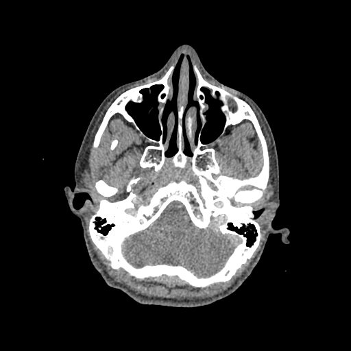 Nasal pyogenic granuloma (lobular capillary hemangioma) (Radiopaedia 85536-101244 C 72).jpg