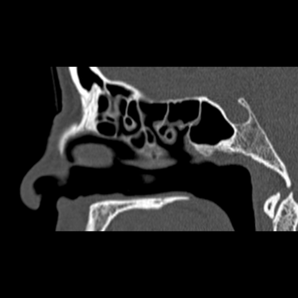 Nasal septal perforation (Radiopaedia 25030-25289 Sagittal bone window 35).jpg