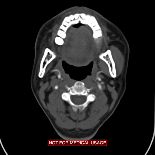 File:Nasopharyngeal carcinoma recurrence - skull base destruction (Radiopaedia 29107-29491 A 17).jpg