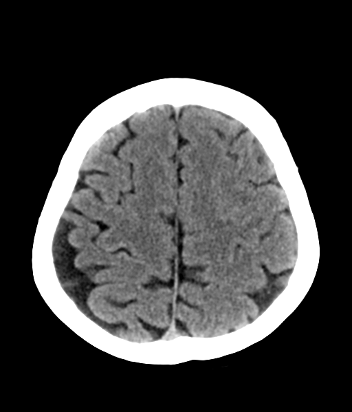 File:Nasopharyngeal carcinoma with cerebral abscess (Radiopaedia 43018-46275 Axial non-contrast 41).png