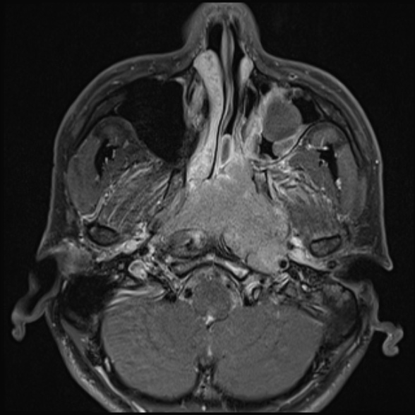 Nasopharyngeal carcinoma with skull base invasion (Radiopaedia 53415-59485 Axial T1 C+ fat sat 26).jpg