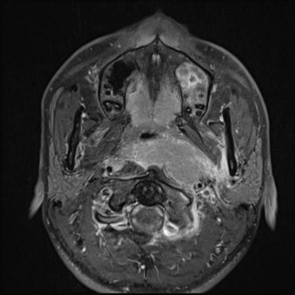 Nasopharyngeal carcinoma with skull base invasion (Radiopaedia 53415-59485 Axial T1 C+ fat sat 32).jpg