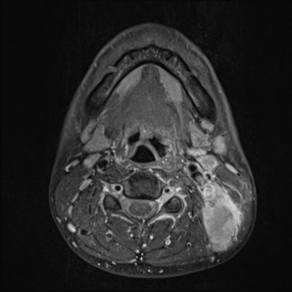Nasopharyngeal carcinoma with skull base invasion (Radiopaedia 53415-59485 Axial T1 C+ fat sat 48).jpg