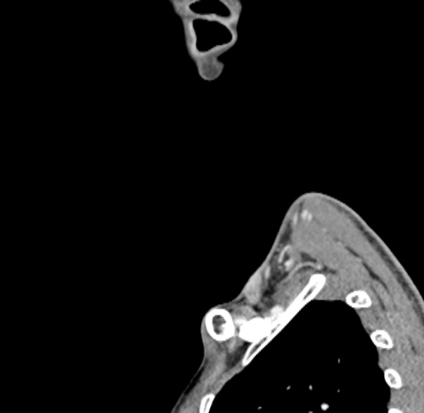 File:Nasopharyngeal carcinoma with skull base invasion (Radiopaedia 53415-59705 C 1).jpg