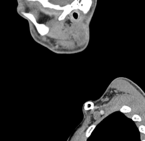 Nasopharyngeal carcinoma with skull base invasion (Radiopaedia 53415-59705 C 68).jpg