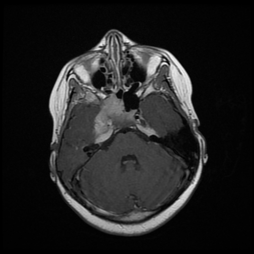 File:Nasopharyngeal rhabdomyosarcoma (Radiopaedia 23417-23486 Axial T1 C+ 10).jpg