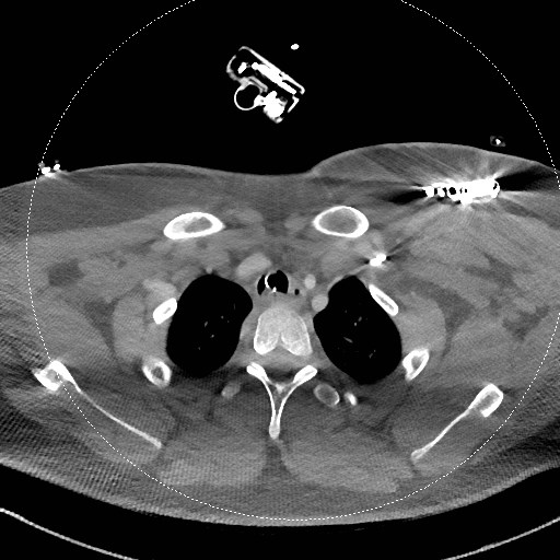 Neck CT angiogram (intraosseous vascular access) (Radiopaedia 55481-61945 B 89).jpg