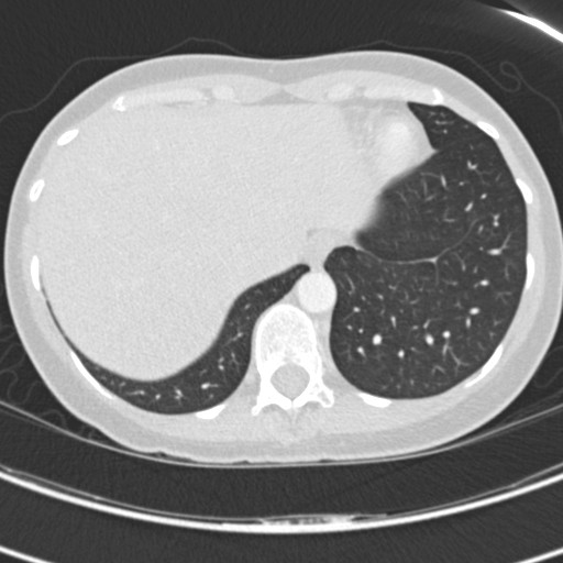 Necrobiotic pulmonary nodules - Crohn disease (Radiopaedia 20723-20631 Axial lung window 120).jpg