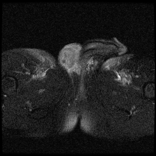 File:Necrotizing epididymo-orchitis with intra-testicular abscess (Radiopaedia 29397-29860 Axial T2 fat sat 11).jpg