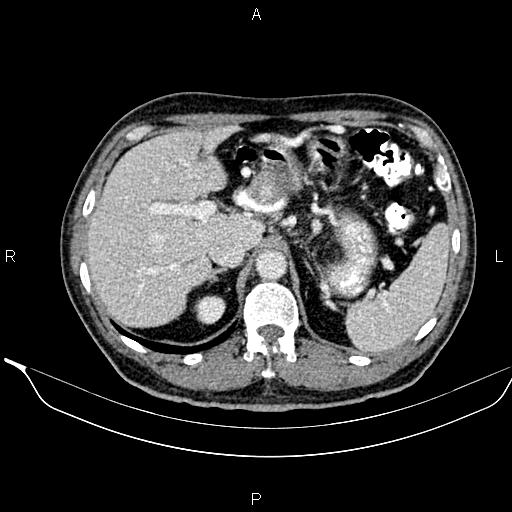 Necrotizing pancreatitis (Radiopaedia 87796-104249 A 16).jpg