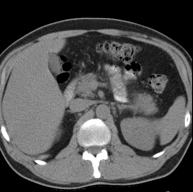 File:Necrotizing pancreatitis with acute necrotic collection (Radiopaedia 14470-14417 Axial non-contrast 12).jpg