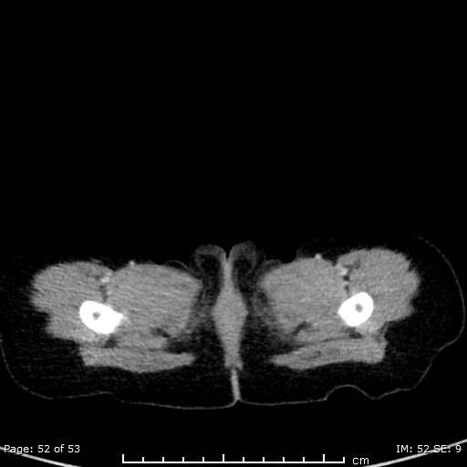 File:Nephroblastomatosis (Radiopaedia 41934-44935 A 52).jpg