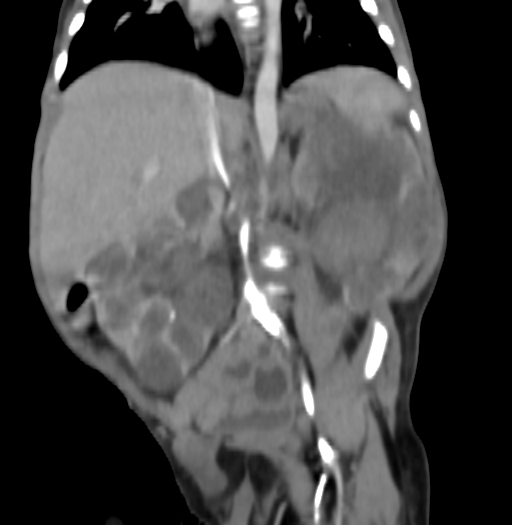 Nephroblastomatosis (Radiopaedia 71294-81607 B 207).jpg
