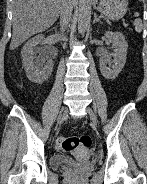 File:Nephrostomy for urosepsis (Radiopaedia 26180-26330 non-contrast 54).jpg