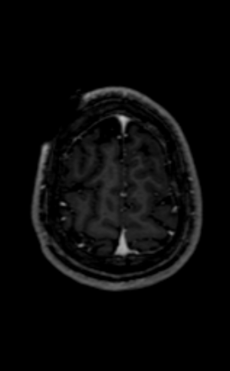 Neuro-Behçet disease (Radiopaedia 90112-107294 Axial T1 C+ 65).jpg