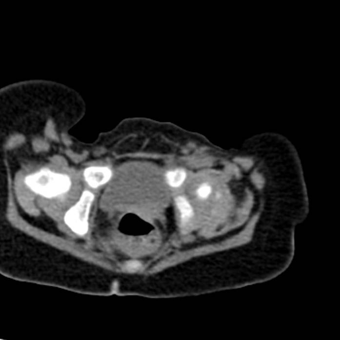Neuroblastoma with skull metastases (Radiopaedia 30326-30960 Axial non-contrast 59).jpg