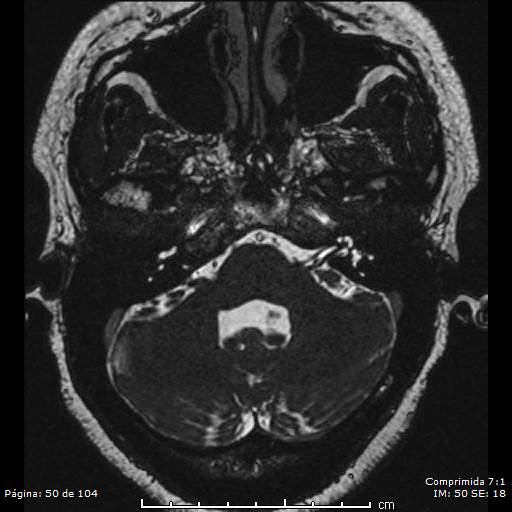 Neurocysticercosis (Radiopaedia 58636-65832 I 50).jpg
