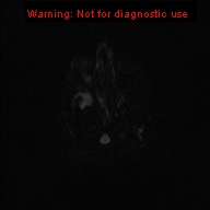 File:Neurofibromatosis type 1 with optic nerve glioma (Radiopaedia 16288-15965 Axial DWI 68).jpg