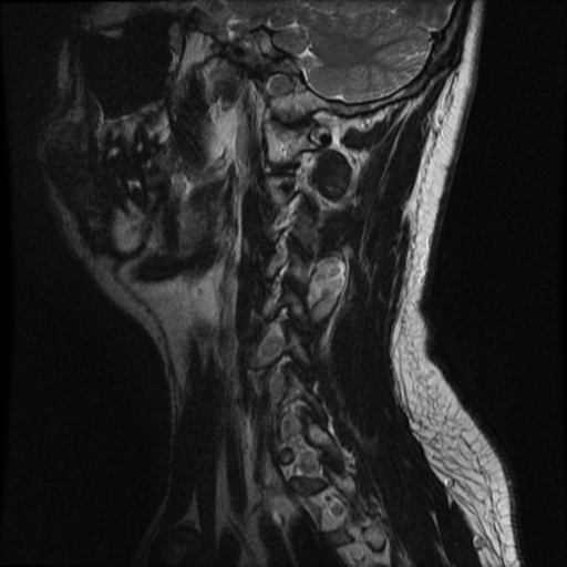 File:Neurofibromatosis type 2 (Radiopaedia 44936-48837 Sagittal T2 3).png