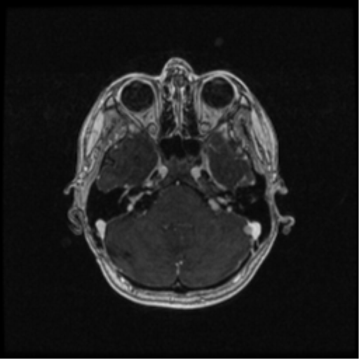 Neurofibromatosis type 2 (Radiopaedia 45229-49244 Axial T1 C+ 39).png