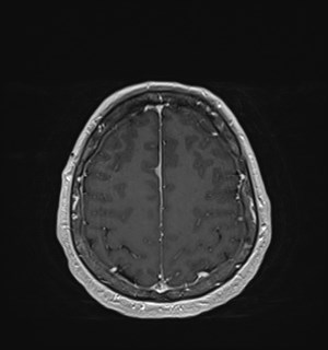 Neurofibromatosis type 2 (Radiopaedia 79097-92049 Axial T1 C+ 157).jpg