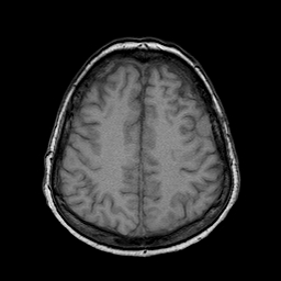 File:Neurofibromatosis type 2 (Radiopaedia 8713-9518 Axial T1 7).jpg