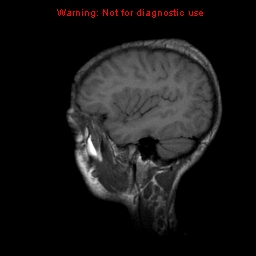 File:Neurofibromatosis type 2 (Radiopaedia 8953-9730 Sagittal T1 4).jpg