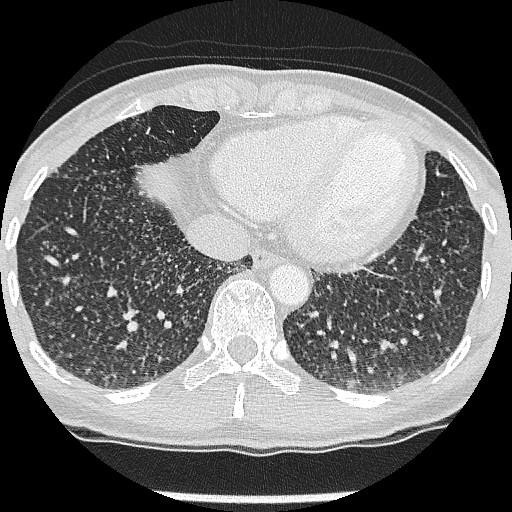 File:Non-small cell lung cancer with miliary metastases (Radiopaedia 23995-24193 Axial lung window 19).jpg