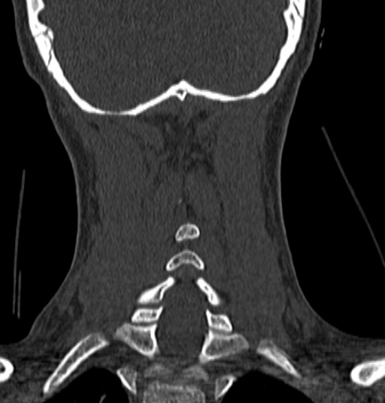 File:Normal CT cervical spine - 12-year-old (Radiopaedia 55352-61775 Coronal bone window 172).jpg