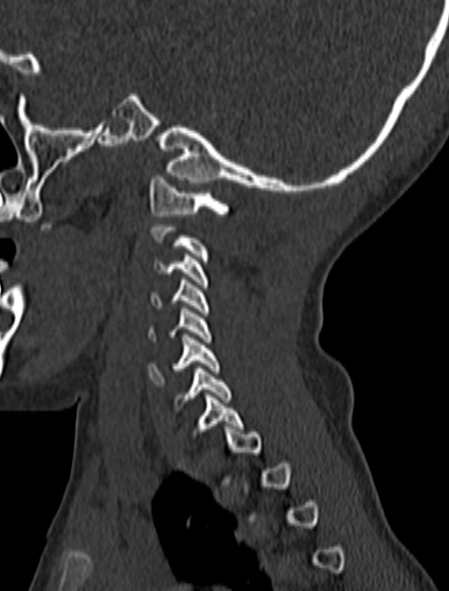 File:Normal CT cervical spine - pediatric (Radiopaedia 52549-58462 Sagittal bone window 38).jpg