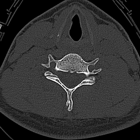 Normal CT of the cervical spine (Radiopaedia 53322-59305 Axial bone window 184).jpg