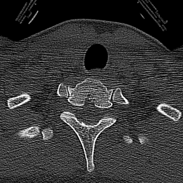 Normal CT of the cervical spine (Radiopaedia 53322-59305 Axial bone window 238).jpg